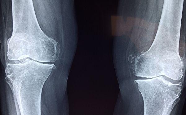 O tumor era benigno