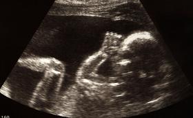 Un fetus no era viable