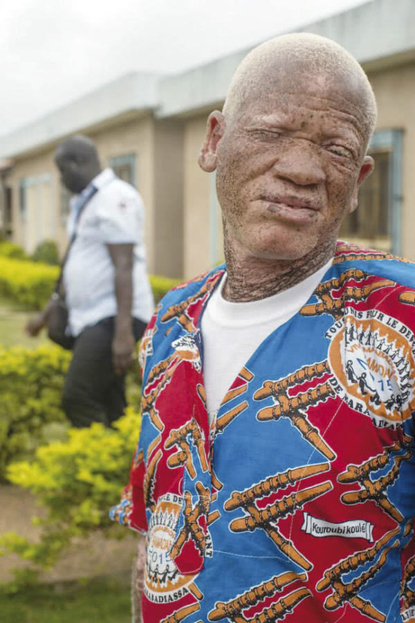 Un hombre albino. Foto: Ismael Martínez Sánchez